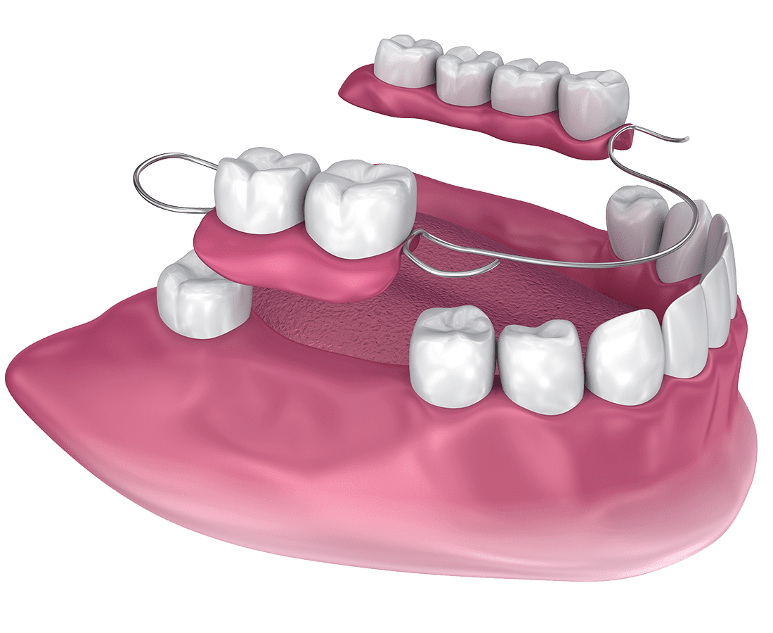 3D illustration of a dental partial denture, showing artificial teeth attached to a pink gum base with metal clasps, positioned above the lower jaw where teeth are missing.